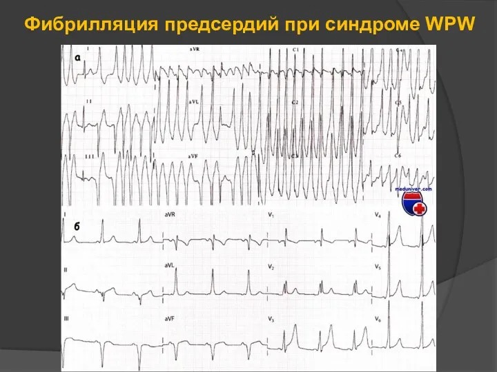 Фибрилляция предсердий при синдроме WPW