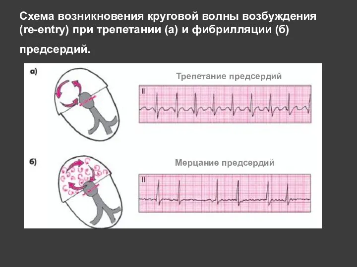 Схема возникновения круговой волны возбуждения (re-entry) при трепетании (а) и