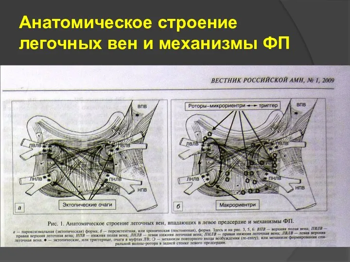 Анатомическое строение легочных вен и механизмы ФП