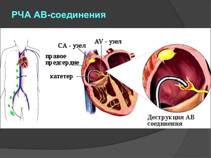 РЧА АВ-соединения