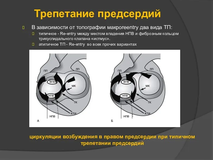 Трепетание предсердий В зависимости от топографии макроreentry два вида ТП: