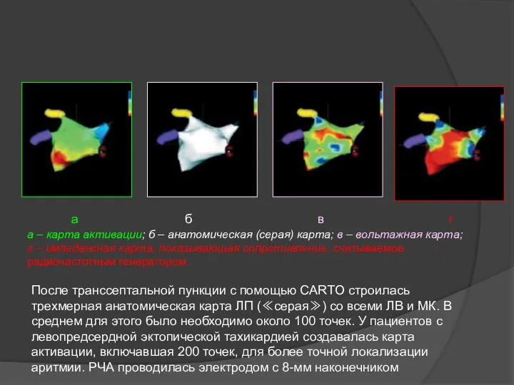 После транссептальной пункции с помощью CARTO строилась трехмерная анатомическая карта