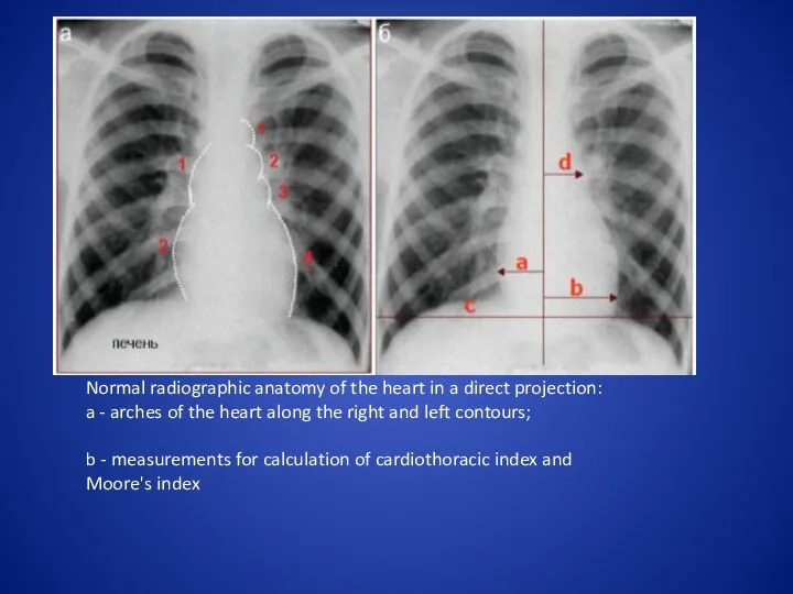 Normal radiographic anatomy of the heart in a direct projection: a - arches