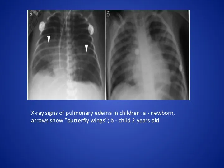 X-ray signs of pulmonary edema in children: a - newborn, arrows show "butterfly
