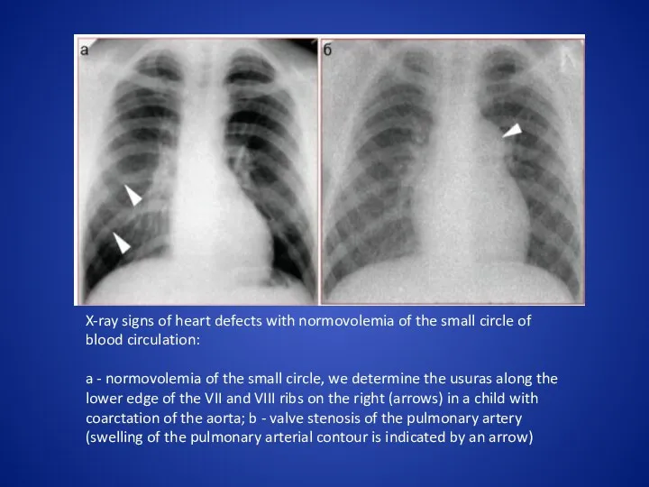 X-ray signs of heart defects with normovolemia of the small circle of blood