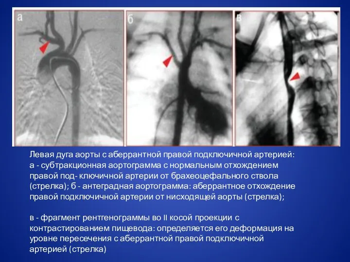 Левая дуга аорты с аберрантной правой подключичной артерией: а - субтракционная аортограмма с