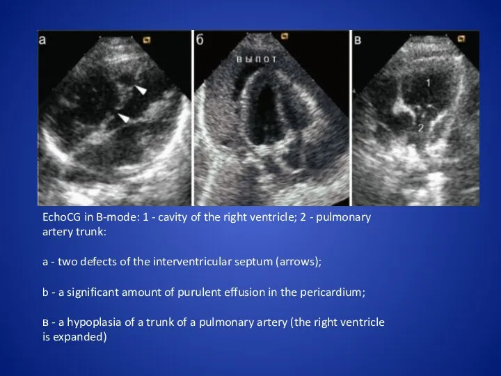 EchoCG in B-mode: 1 - cavity of the right ventricle; 2 - pulmonary