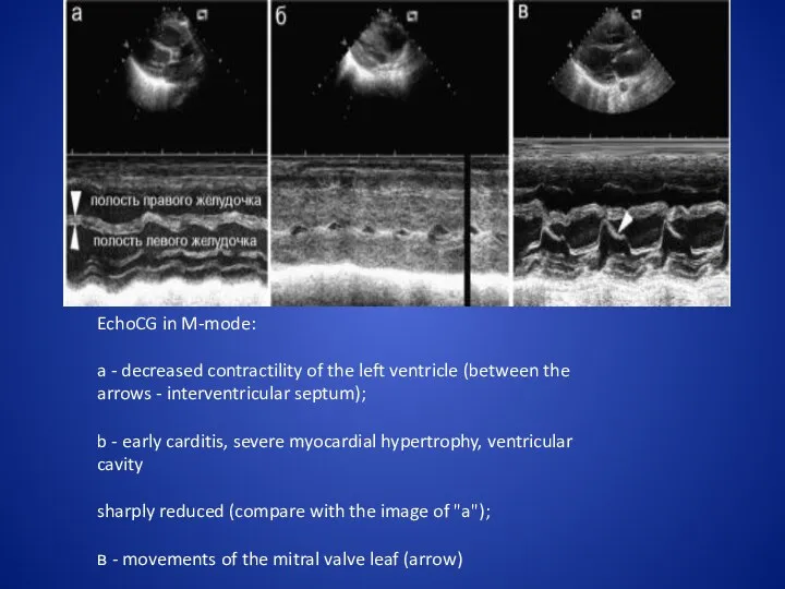 EchoCG in M-mode: a - decreased contractility of the left ventricle (between the