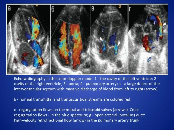 Echocardiography in the color doppler mode: 1 - the cavity