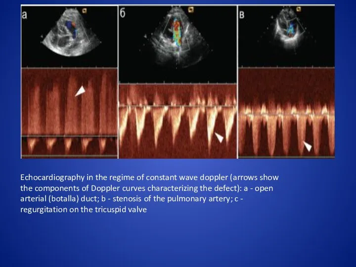 Echocardiography in the regime of constant wave doppler (arrows show the components of