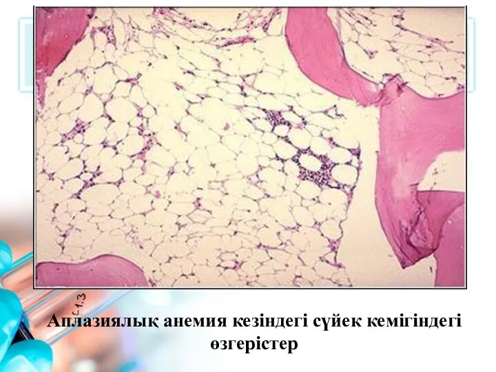 Аплазиялық анемия кезіндегі сүйек кемігіндегі өзгерістер