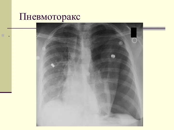 Пневмоторакс .