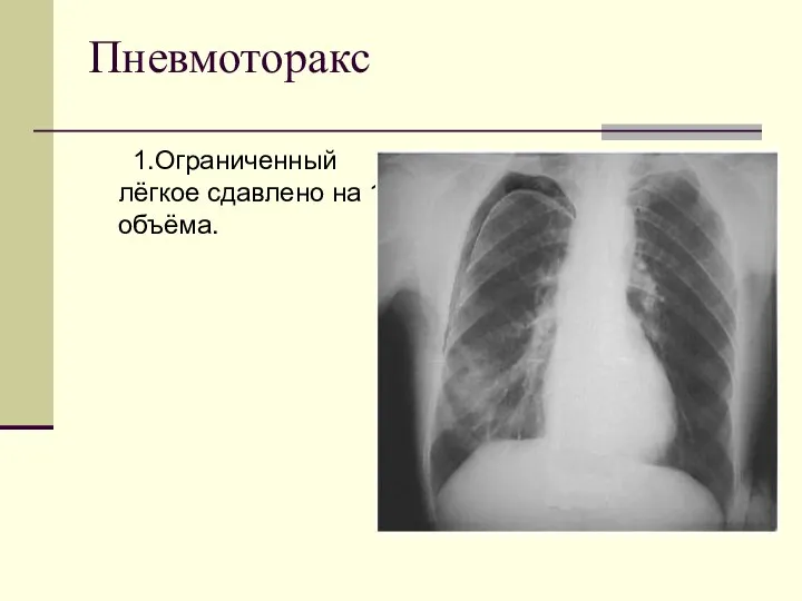 Пневмоторакс 1.Ограниченный лёгкое сдавлено на 1/3 объёма.