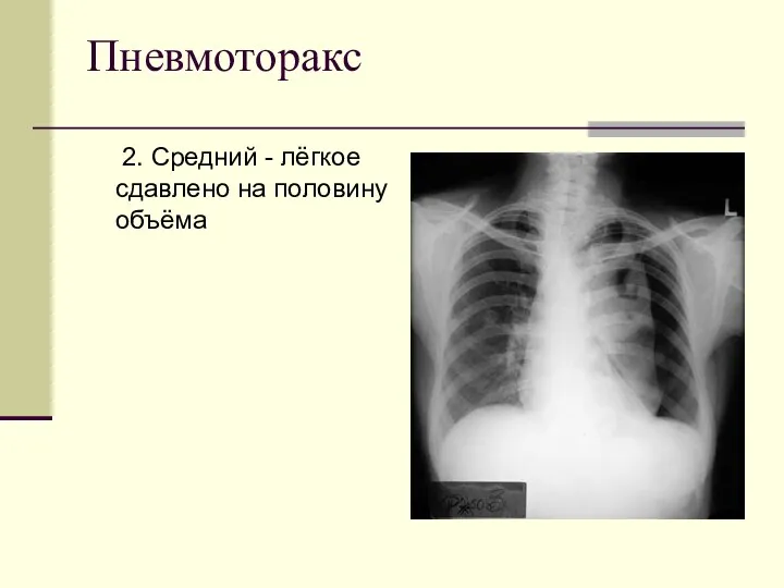 Пневмоторакс 2. Средний - лёгкое сдавлено на половину объёма