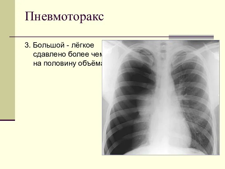 Пневмоторакс 3. Большой - лёгкое сдавлено более чем на половину объёма.