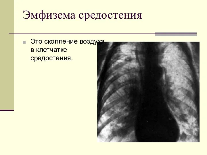 Эмфизема средостения Это скопление воздуха в клетчатке средостения.