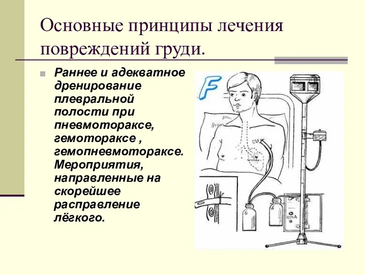 Основные принципы лечения повреждений груди. Раннее и адекватное дренирование плевральной