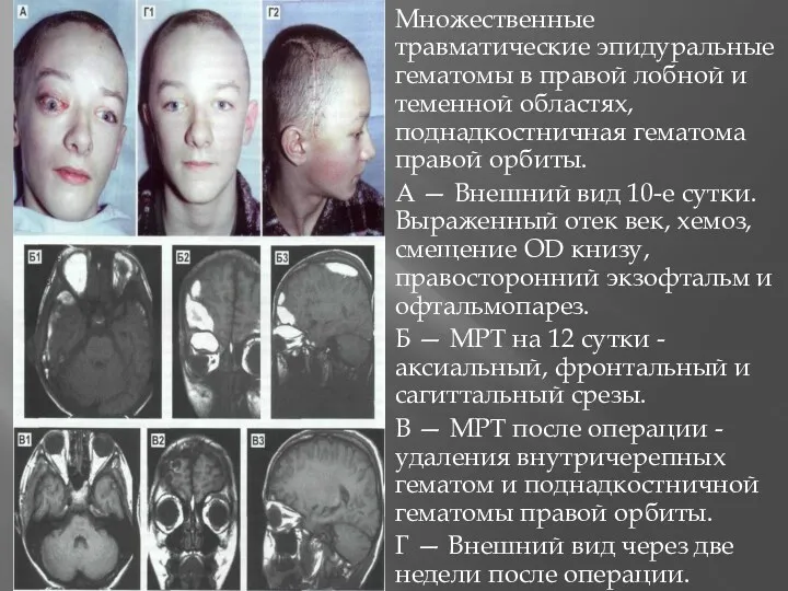 Множественные травматические эпидуральные гематомы в правой лобной и теменной областях,