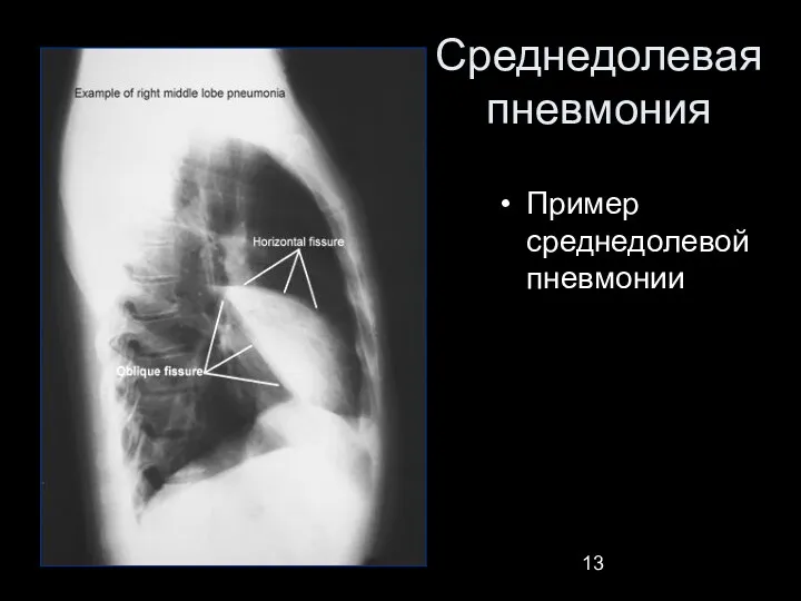 Среднедолевая пневмония Пример среднедолевой пневмонии