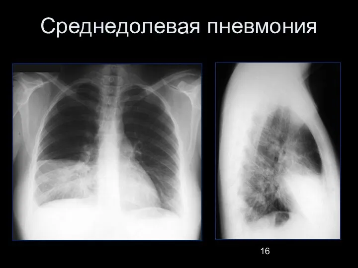 Среднедолевая пневмония