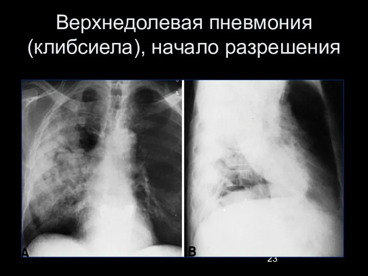 Верхнедолевая пневмония (клибсиела), начало разрешения