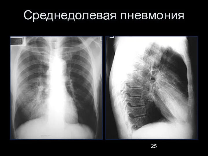 Среднедолевая пневмония