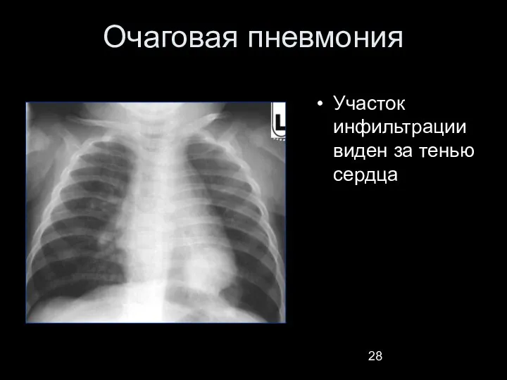 Очаговая пневмония Участок инфильтрации виден за тенью сердца