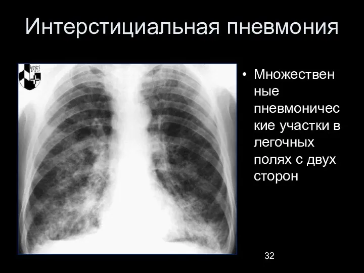 Интерстициальная пневмония Множественные пневмонические участки в легочных полях с двух сторон