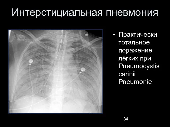 Интерстициальная пневмония Практически тотальное поражение лёгких при Pneumocystis carinii Pneumonie