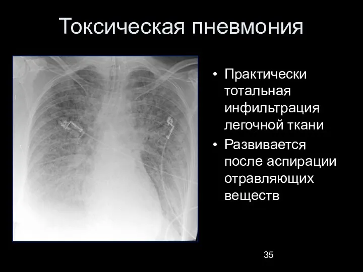 Токсическая пневмония Практически тотальная инфильтрация легочной ткани Развивается после аспирации отравляющих веществ