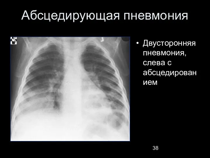 Абсцедирующая пневмония Двусторонняя пневмония, слева с абсцедированием