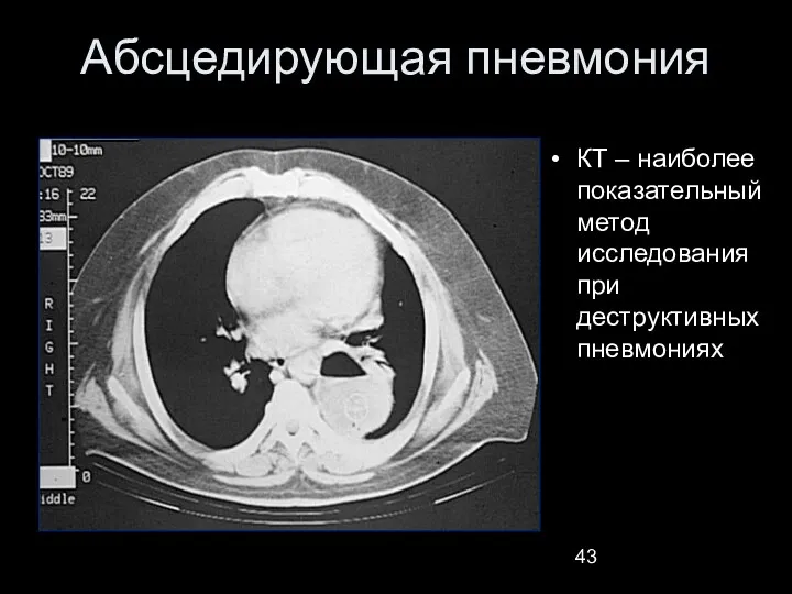 Абсцедирующая пневмония КТ – наиболее показательный метод исследования при деструктивных пневмониях