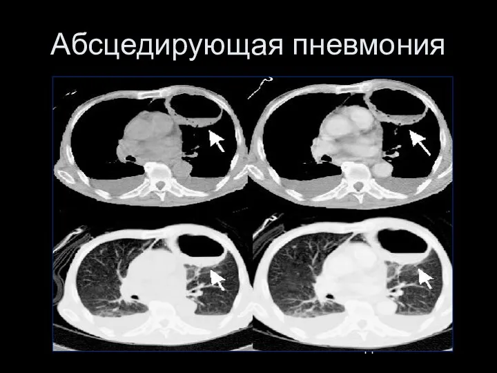 Абсцедирующая пневмония