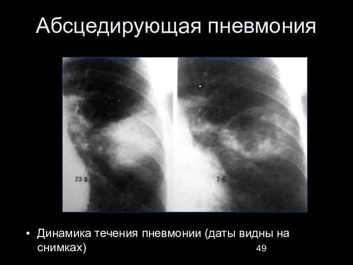 Абсцедирующая пневмония Динамика течения пневмонии (даты видны на снимках)