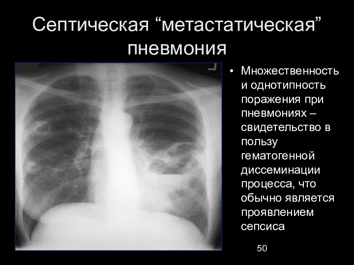 Септическая “метастатическая” пневмония Множественность и однотипность поражения при пневмониях –