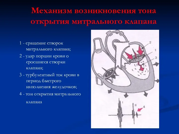 Механизм возникновения тона открытия митрального клапана 1 - сращение створок