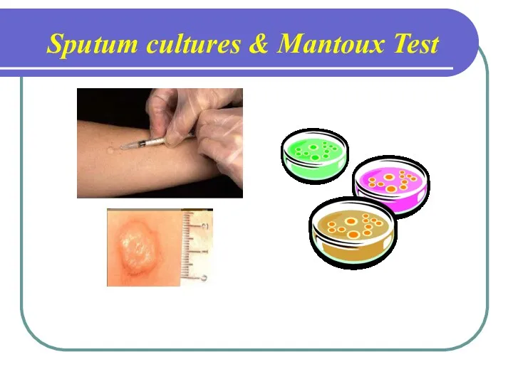 Sputum cultures & Mantoux Test