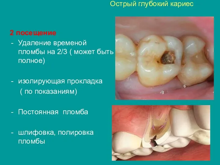 Острый глубокий кариес 2 посещение Удаление временой пломбы на 2/3