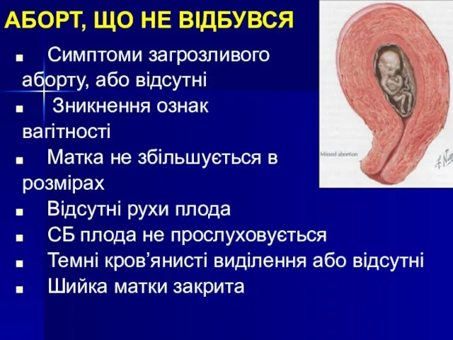 АБОРТ, ЩО НЕ ВІДБУВСЯ Симптоми загрозливого аборту, або відсутні Зникнення