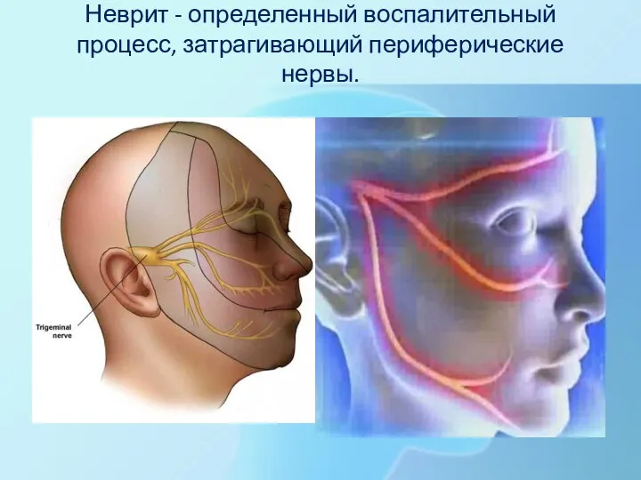 Неврит - определенный воспалительный процесс, затрагивающий периферические нервы.