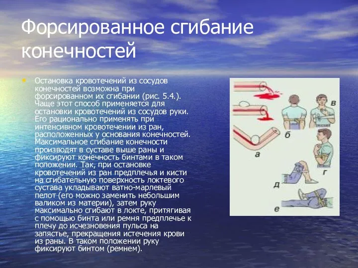 Форсированное сгибание конечностей Остановка кровотечений из сосудов конечностей возможна при