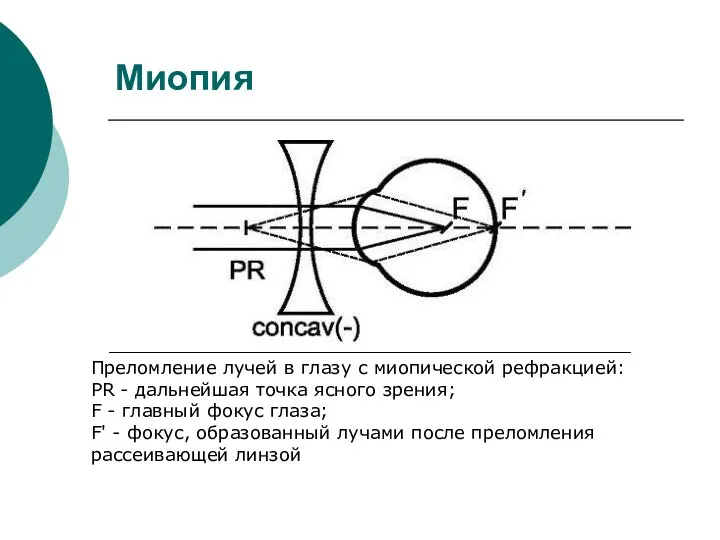 Миопия Преломление лучей в глазу с миопической рефракцией: PR -