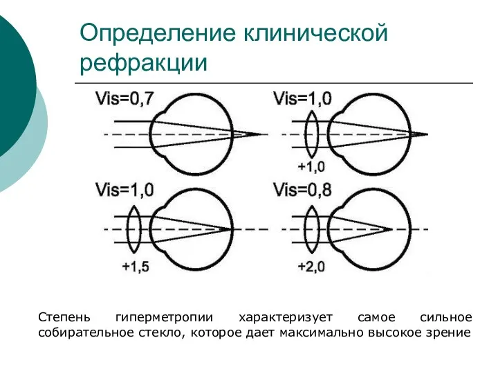 Определение клинической рефракции Степень гиперметропии характеризует самое сильное собирательное стекло, которое дает максимально высокое зрение