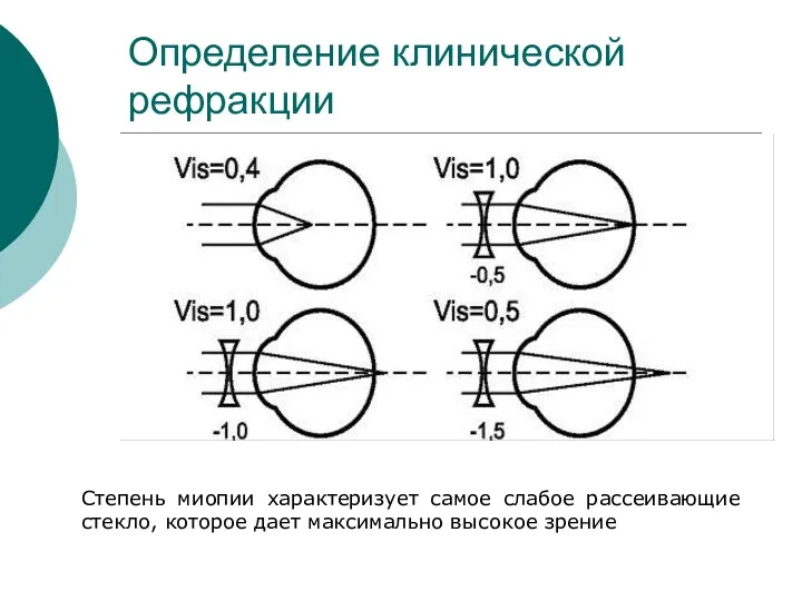 Определение клинической рефракции Степень миопии характеризует самое слабое рассеивающие стекло, которое дает максимально высокое зрение