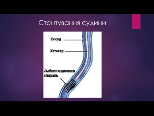 Стентування судини