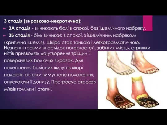 3 стадія (виразково-некротична): 3А стадія - виникають болі в спокої, без ішемічного набряку.