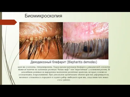 Биомикроскопия края век утолщены, гиперемированы. Характерным признаком блефарита демодекозной этиологии