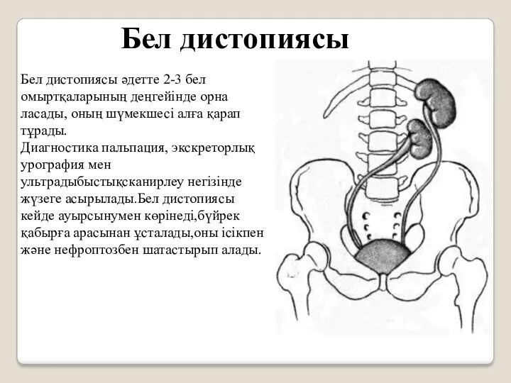 Бел дистопиясы әдетте 2-3 бел омыртқаларының деңгейінде орна­ласады, оның шүмекшесі