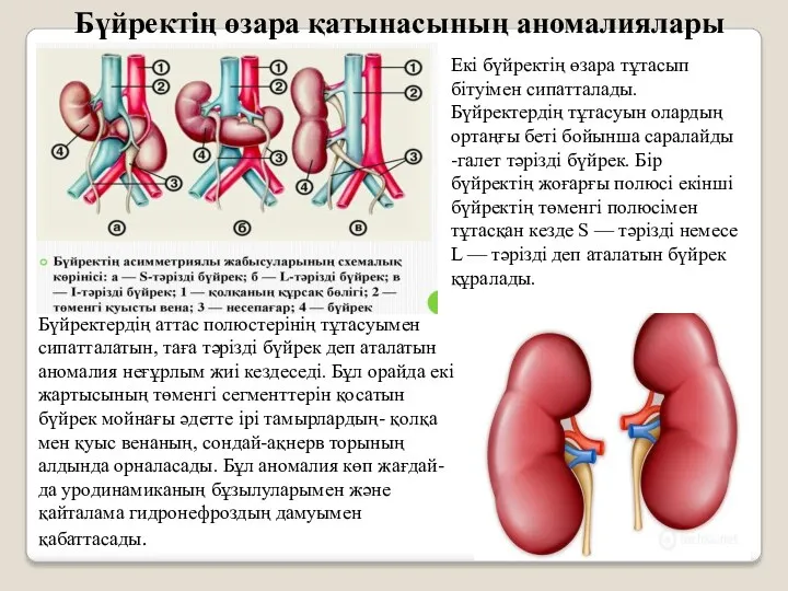 Бүйректің өзара қатынасының аномалиялары Екі бүйректің өзара тұтасып бітуімен сипатталады.