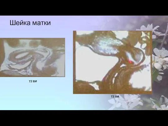 Шейка матки Т2 ВИ Т2 ВИ